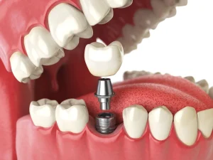 The Impact of Stress Management on Dental Implant Success