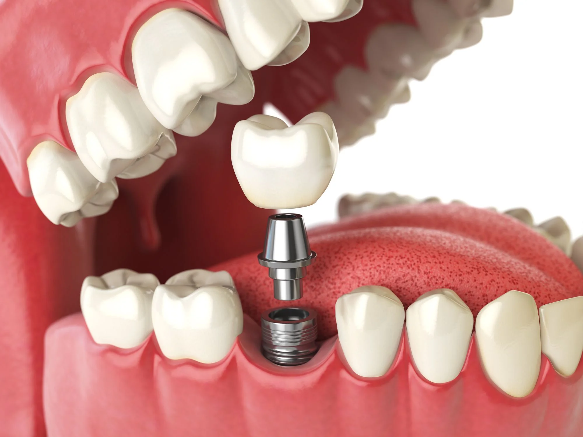 The Impact of Stress Management on Dental Implant Success